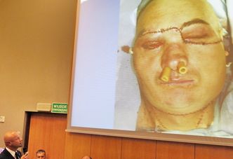 Przeszczep twarzy. Pierwsza taka operacja w Polsce to ogromny sukces