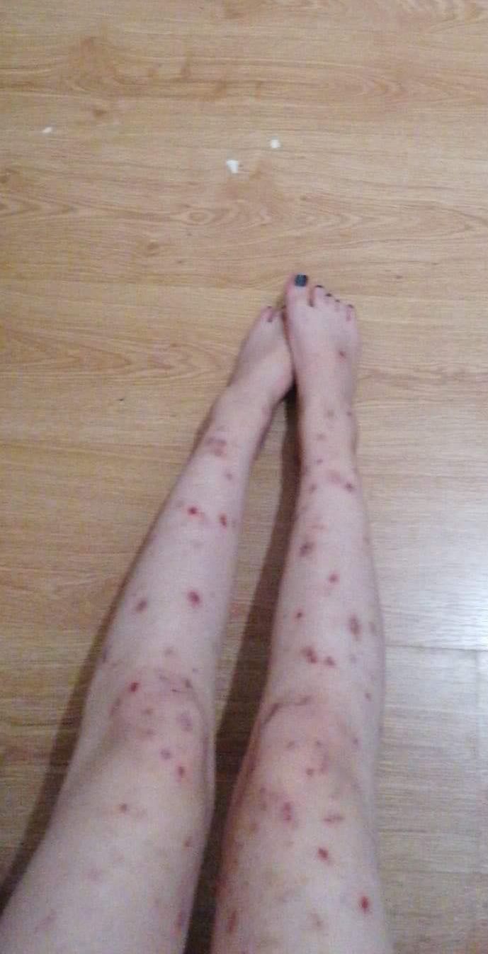 Nasza czytelniczka pokazała, jak wyglądają jej nogi. Kobieta mierzy się z dermatillomanią