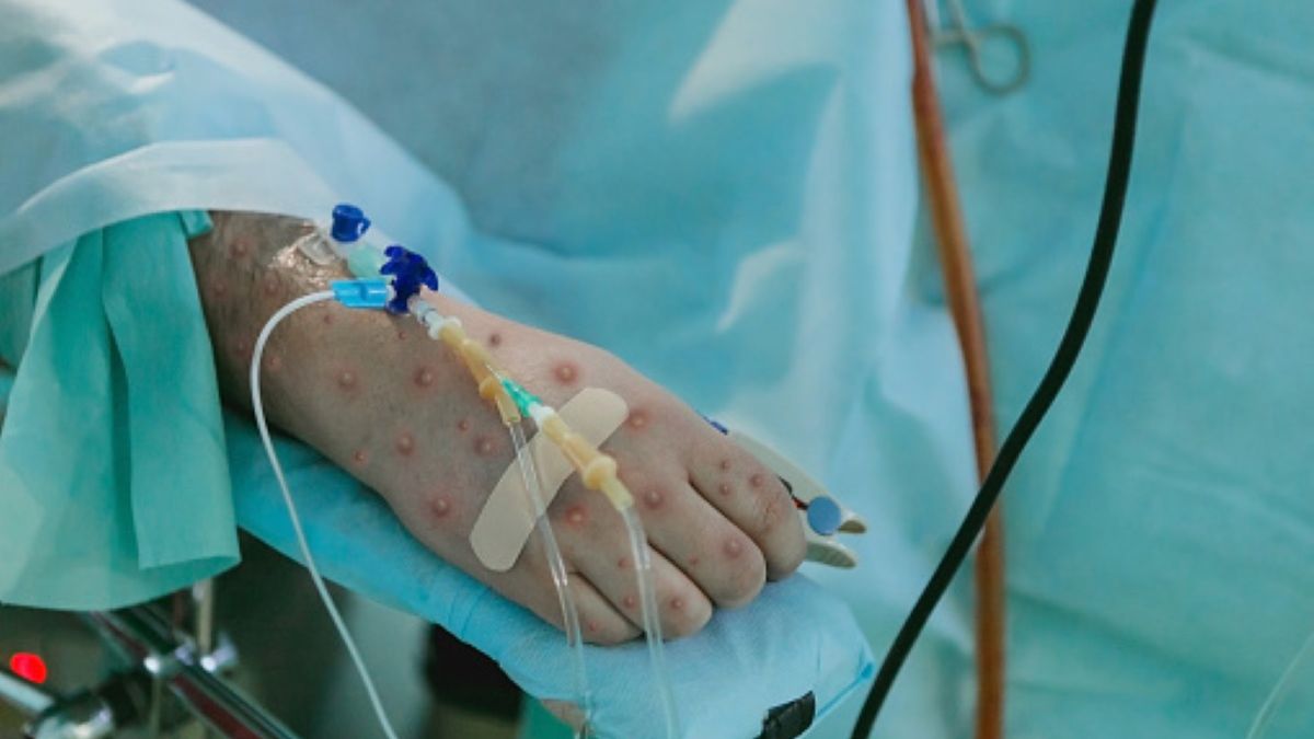 Światowa Organizacja Zdrowia podała, ile oficjalnie osób zachorowało na małpią ospę