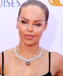 Katie Piper przeszła 400 operacji po oblaniu kwasem. Dziś z dumą pozuje na ściance