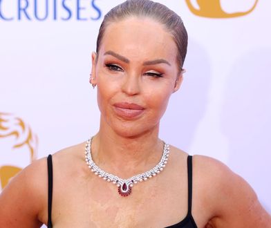 Katie Piper przeszła 400 operacji po oblaniu kwasem. Dziś z dumą pozuje na ściance