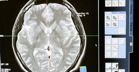 Lekarze nie wiedzą, co się dzieje. Tajemnicza choroba neurologiczna atakuje młodych