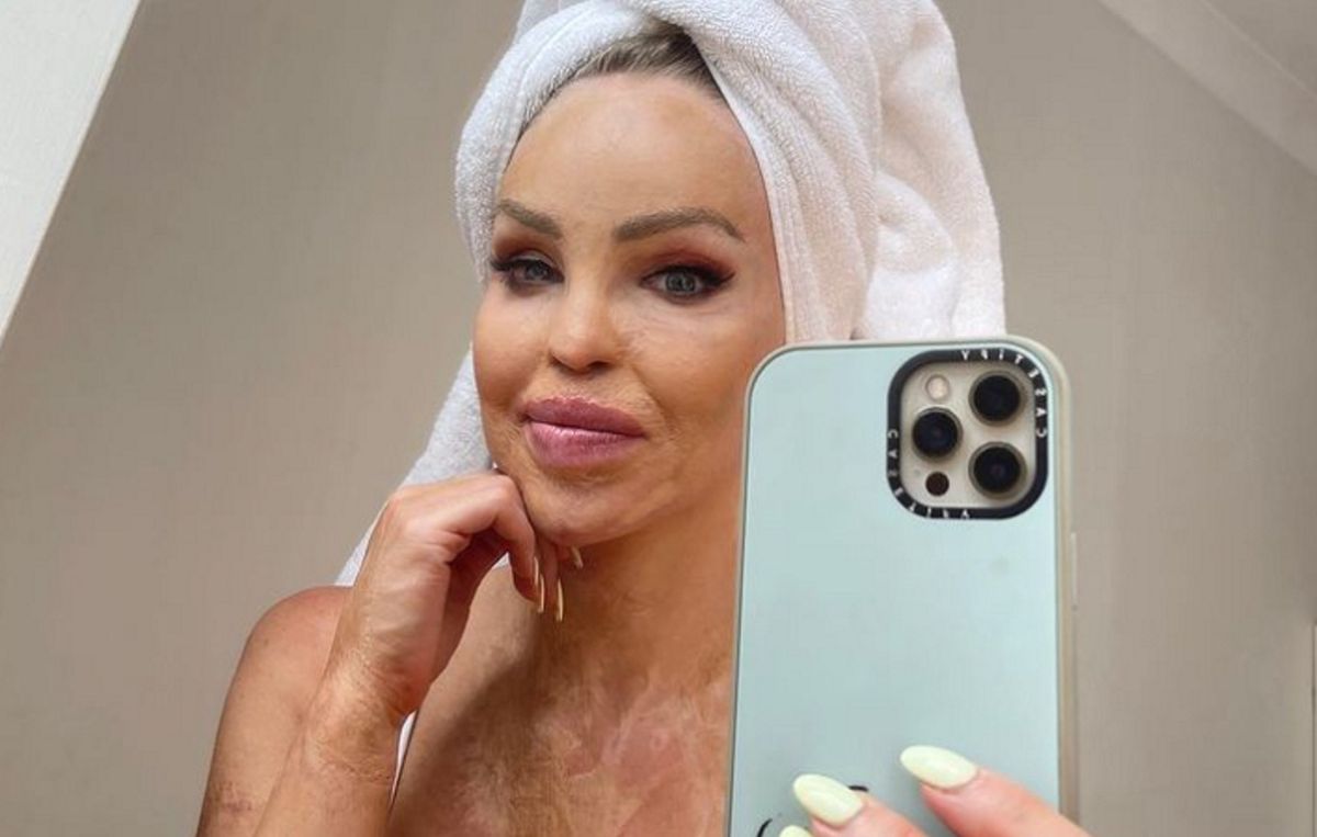 Katie Piper przeszła wiele operacji, aby wyglądać tak jak na zdjęciu. Ale blizn nie da się całkiem usunąć 