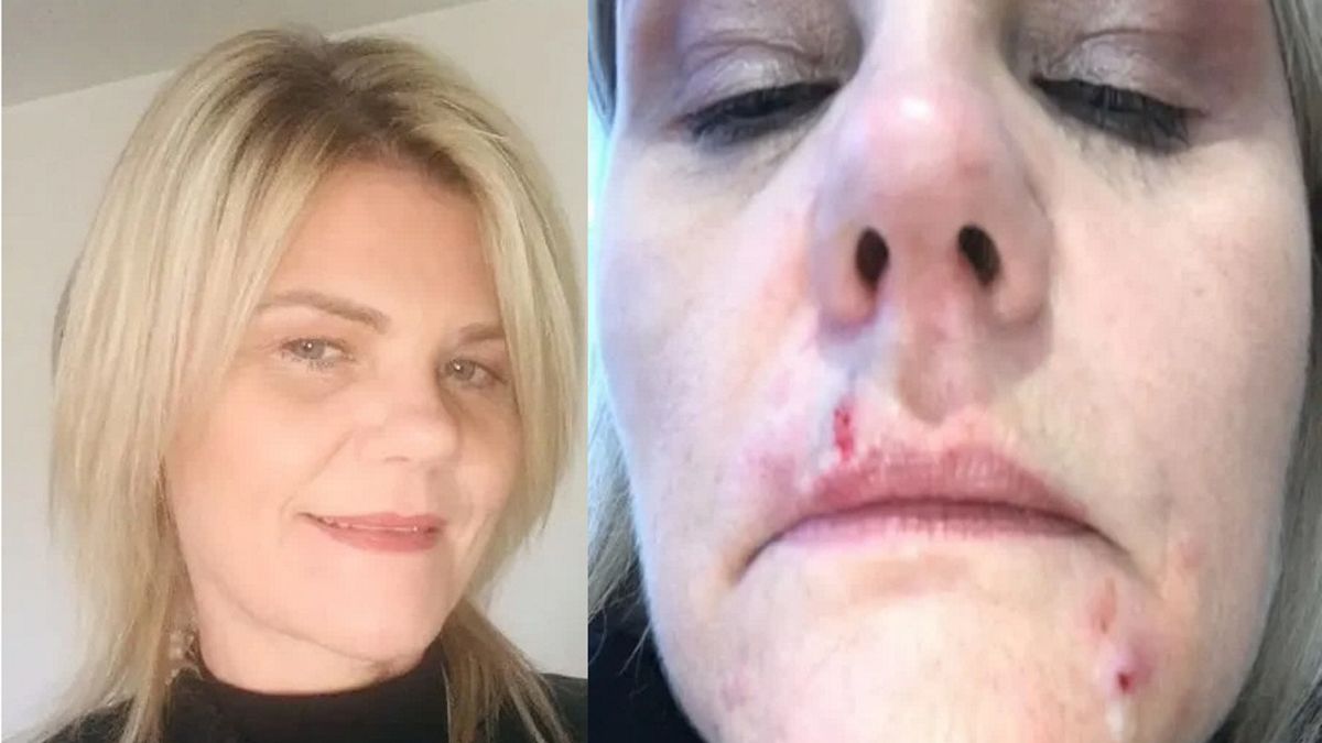 Zamówiła lifting z przeceny. Kobieta pozostała z ranami na twarzy