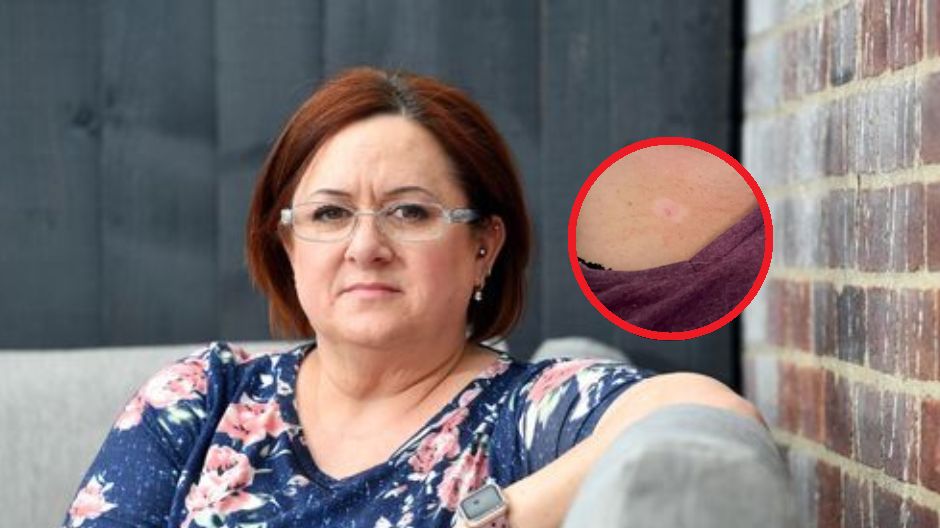 Niewinna zmiana na skórze okazała się być złośliwym nowotworem