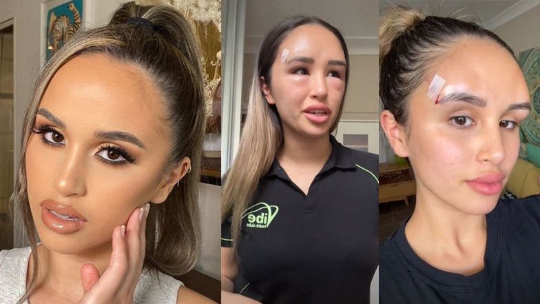 Tiktokerka oszpeciła się zabiegiem 