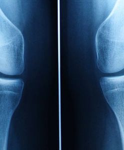 Mężczyźni dwukrotnie bardziej narażeni na zgon z powodu osteoporozy