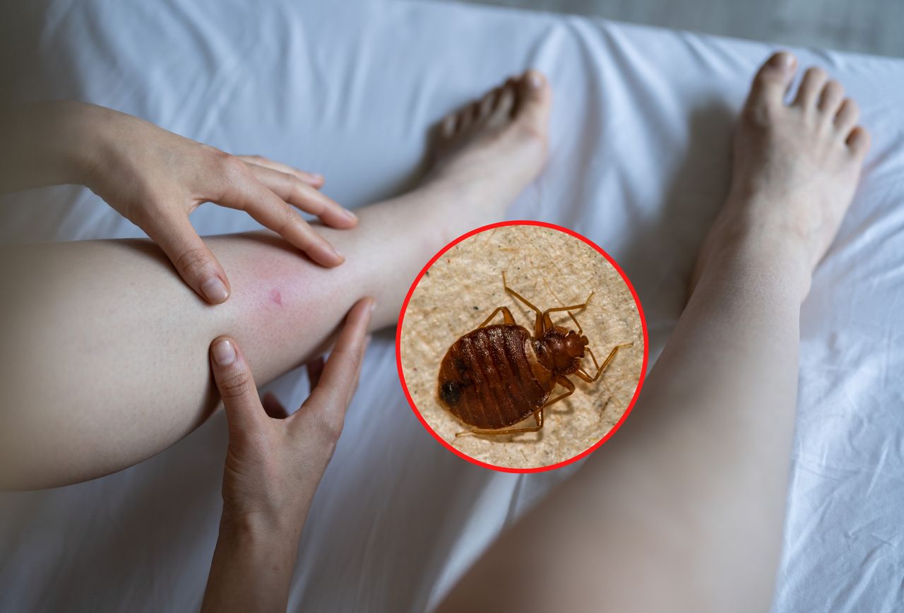 Są prawdziwą plagą w hotelach. Jak rozpoznać ugryzienia pluskwy?