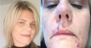Zamówiła lifting z przeceny. Kobieta pozostała z ranami na twarzy