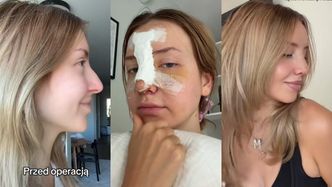 Monika Kociołek zafundowała sobie NOWY NOS. Pokazała efekty PRZED I PO. Zmiana na plus? (ZDJĘCIA)