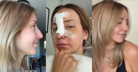 Monika Kociołek zafundowała sobie NOWY NOS. Pokazała efekty PRZED I PO. Zmiana na plus? (ZDJĘCIA)