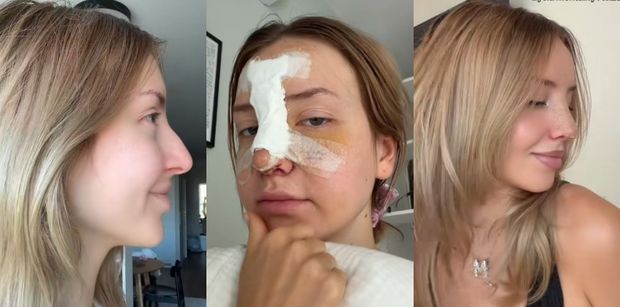 Monika Kociołek zafundowała sobie NOWY NOS. Pokazała efekty PRZED I PO. Zmiana na plus? (ZDJĘCIA)