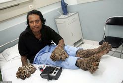 Smutny koniec historii indonezyjskiego Człowieka Drzewo. Umierał samotnie w szpitalu