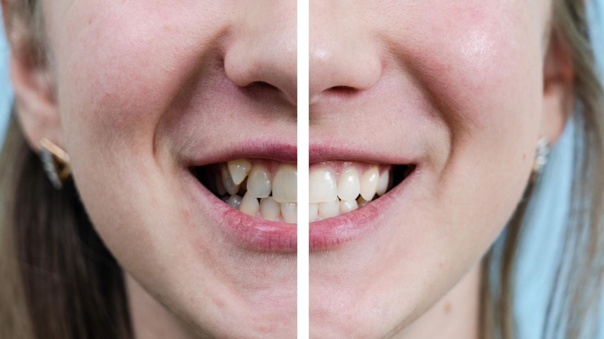 Na czym polega bonding zębów?