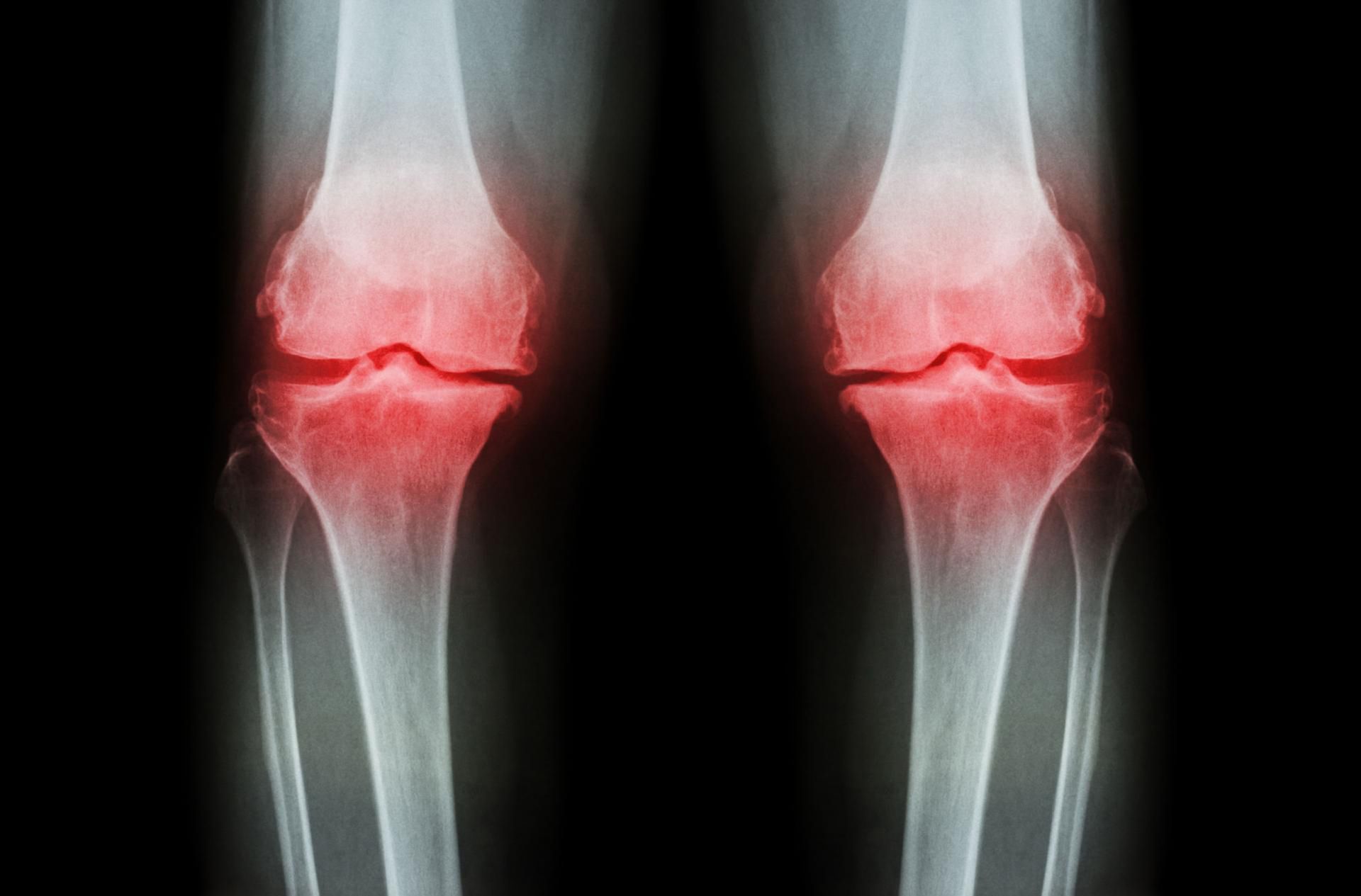 Wielu lekarzy wskazuje, że ich pacjenci zmagający się z zespołem nieszczelnego jelita często skarżą się na bolesność stawów.