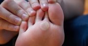 Chcesz usunąć odciski? Sięgnij po kolorową przyprawę z kuchennej szafki
