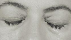 Czerniak to nie tylko rak skóry. 59-latka miała czerniaka oka (WIDEO)