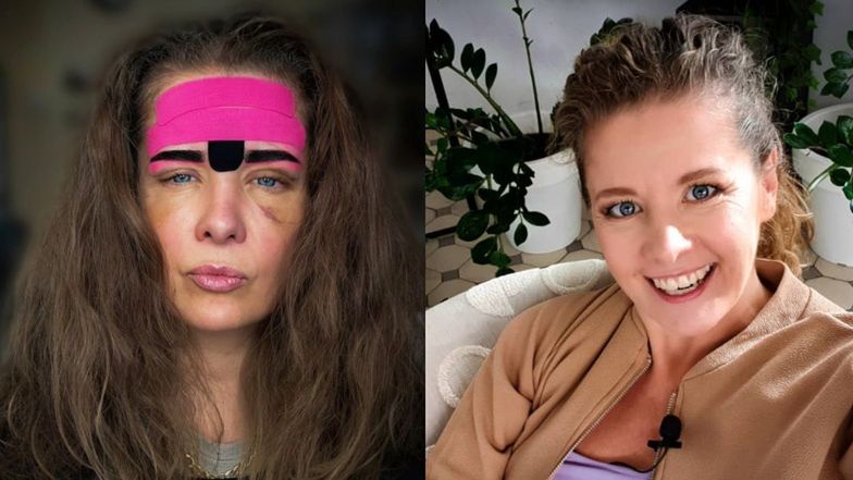 Anna Powierza żałuje stosowania botoksu