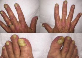 Zespół żółtych paznokci. Przypadek 70-latka z nietypowymi objawami 