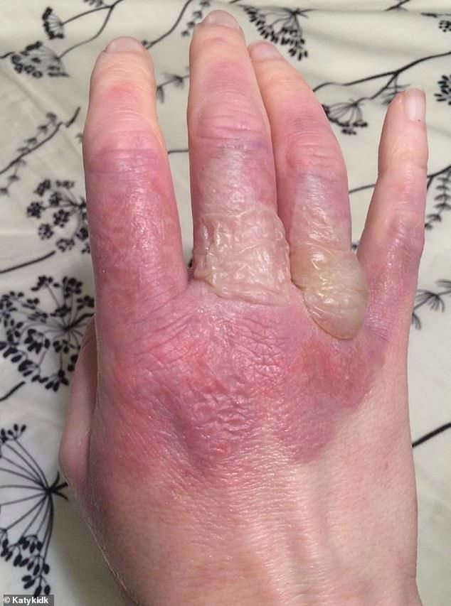 Oparzenie na skórze było wynikiem reakcji soku z limonki z promieniami słonecznymi