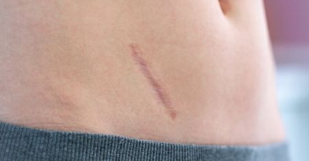 Usunięcie wyrostka robaczkowego (appendektomia) - przebieg laparoskopii, efekty uboczne zabiegu