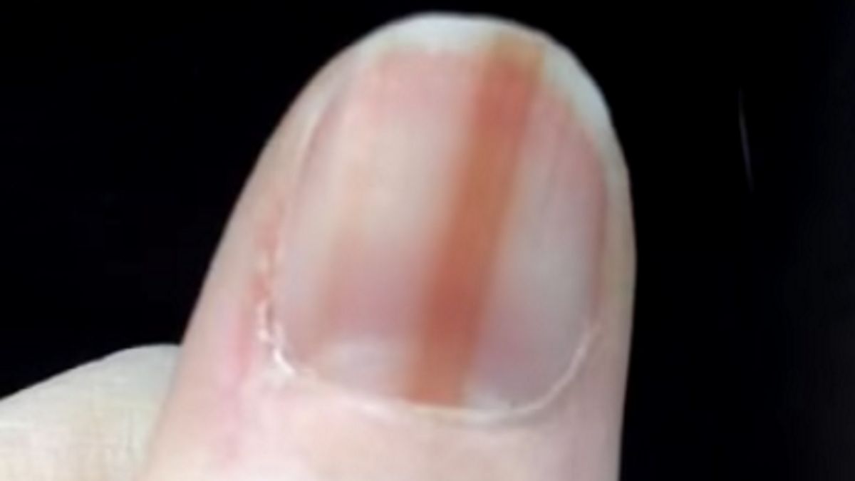 Zdjęcie ilustracyjne. Dokładnie taką linię na paznokciu miała 36-letnia pielęgniarka