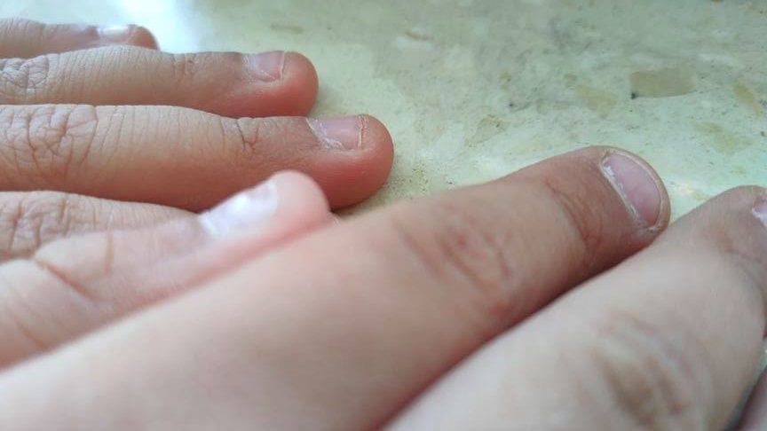 Linie Beau na paznokciach. Mogą świadczyć o przejściu choroby Kawasakiego lub zapalenia płuc