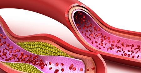 Produkty, które czyszczą tętnice ze złogów cholesterolu (WIDEO)