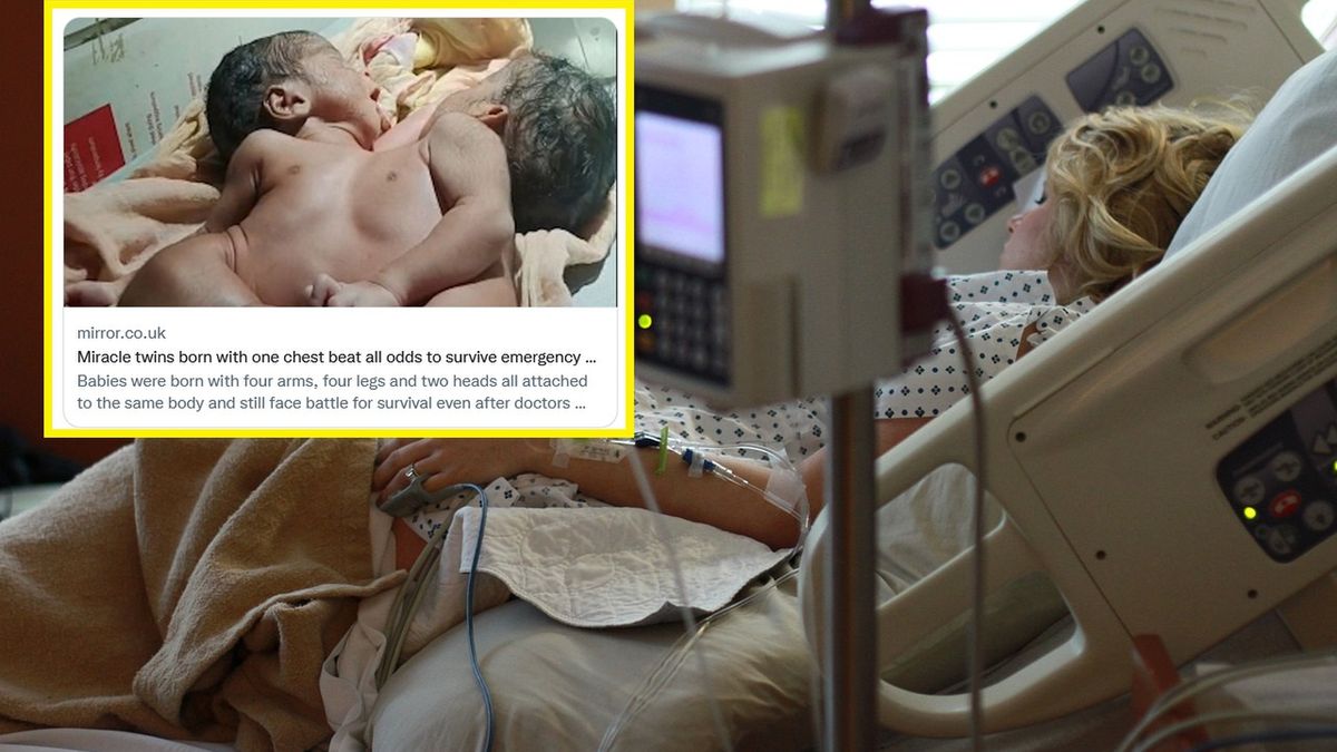 Lekarze twierdzą, że to cud. Mają jedną klatkę piersiową