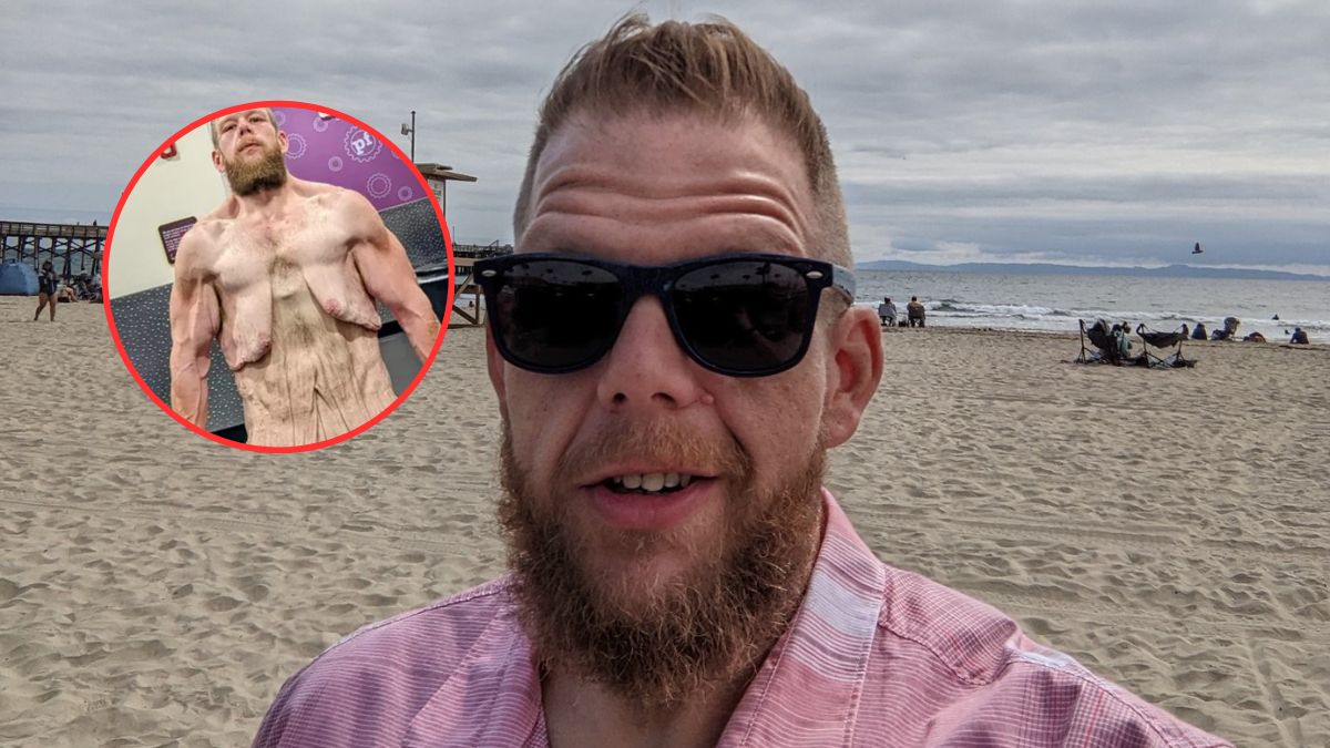 Schudł, ale boryka się z problemem nadmiaru skóry