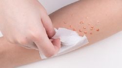 Mięczak zakaźny - po czym go rozpoznać i jak go leczyć