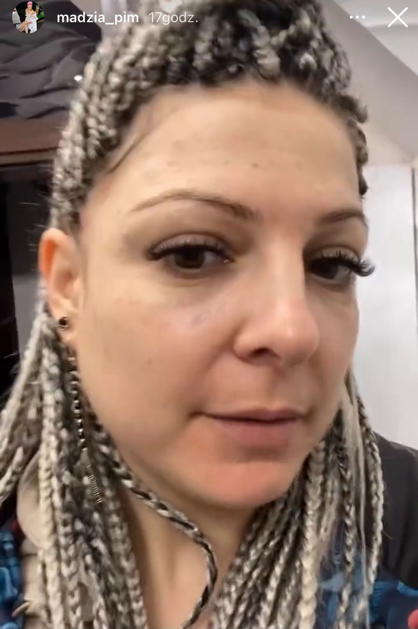 Magda Narożna poddało się zabiegowi medycyny estetycznej