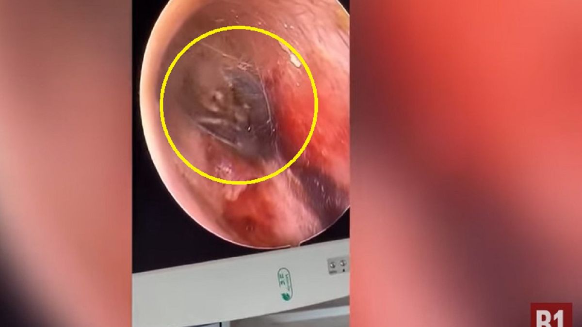 Szok! To zamieszkało w jego uchu.