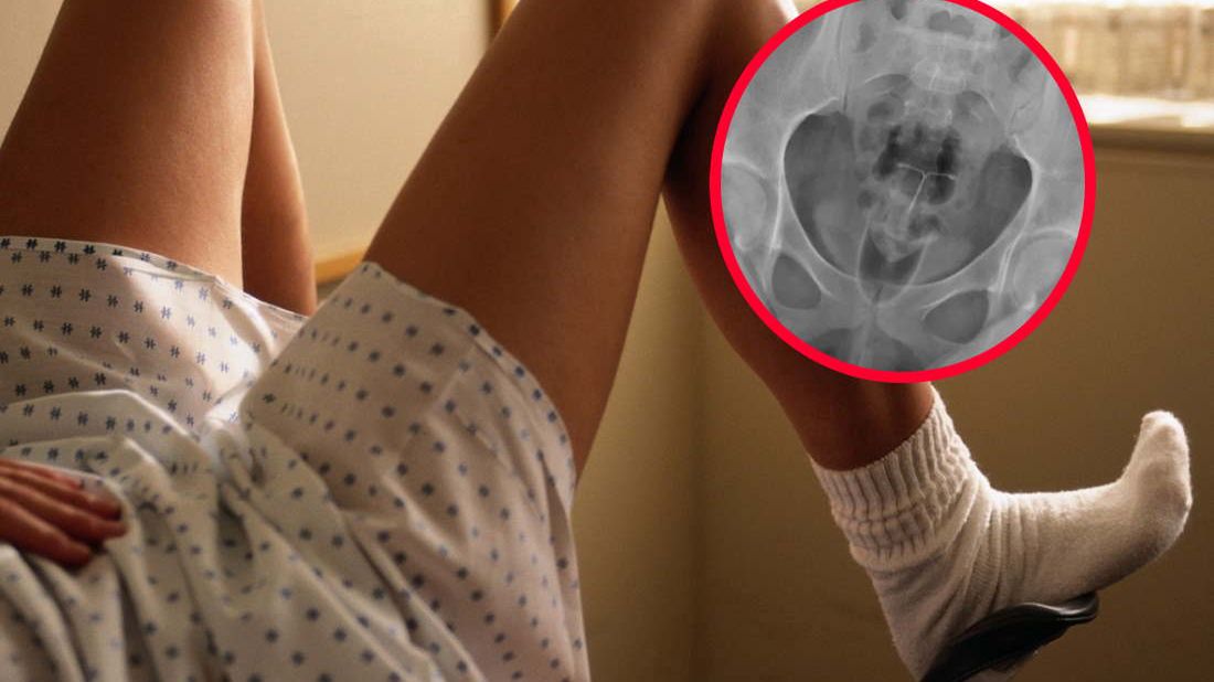 Przez 20 lat używała tej samej wkładki domacicznej. Przedmiot wrósł w nowotwór