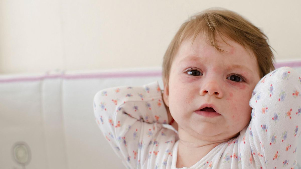 Na różę chorują najczęściej osoby starsze, noworodki i dzieci