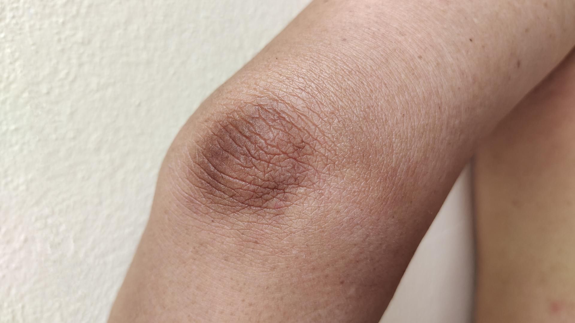 Zmiany skórne przypominają zabrudzenia