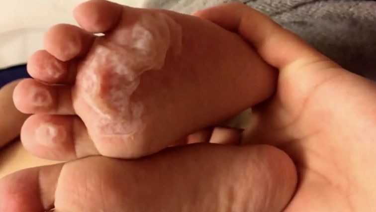 Podczas upałów nie pozwalaj dziecku bawić się na dworze bez butów