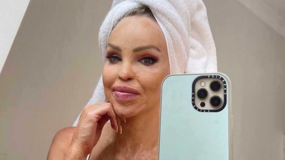 Katie Piper przeszła wiele operacji, aby wyglądać tak jak na zdjęciu. Ale blizn nie da się całkiem usunąć