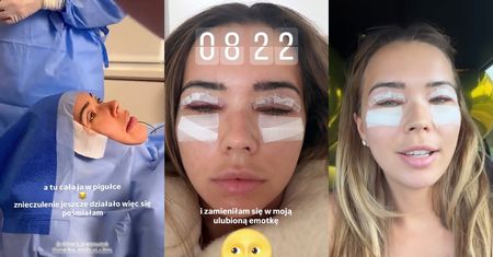 Sandra Kubicka pokazała się PO OPERACJI i ZAPEWNIA, że NIE MAJSTROWAŁA przy dolnych powiekach. "Zaczynają dziać się jakieś spekulacje" (ZDJĘCIA)