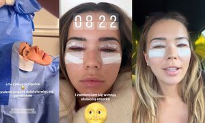 Sandra Kubicka pokazała się PO OPERACJI i ZAPEWNIA, że NIE MAJSTROWAŁA przy dolnych powiekach. "Zaczynają dziać się jakieś spekulacje" (ZDJĘCIA)