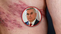 Zmiany w refundacji. Do tej pory szczepionka kosztowała nawet 1000 zł