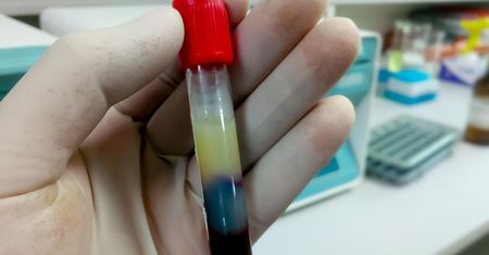 Jak zbić cholesterol bez leków? Wprowadź te zmiany już dziś