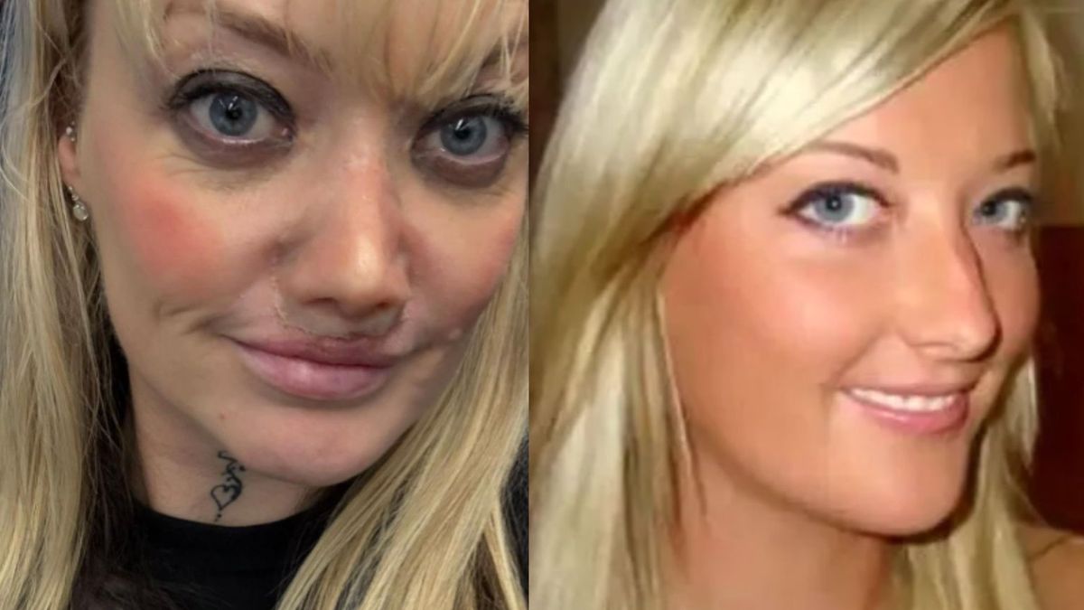 Implanty z Turcji przebijały jej nos