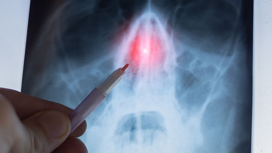 Przeszedłem prostowanie przegordy nosa. Opowiadam, jak było, i obalam mity