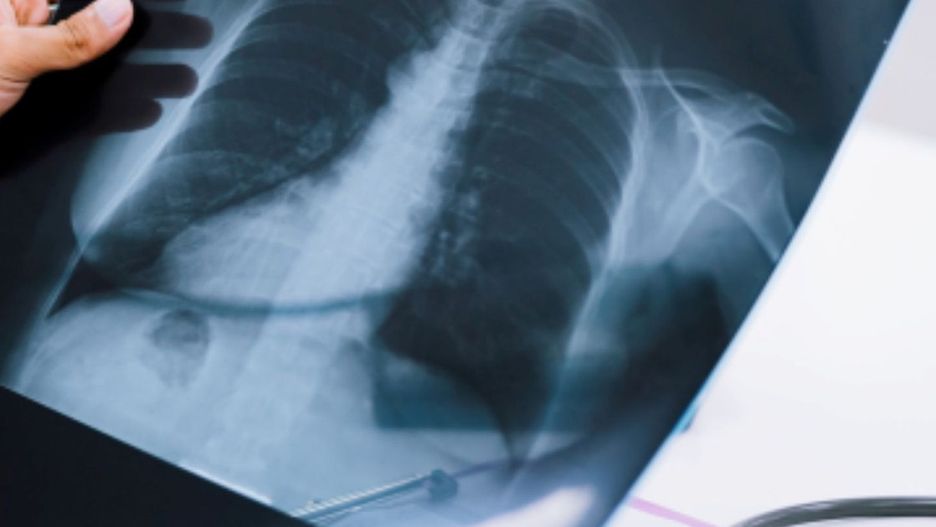 Płuca (źródło: Pixabay)