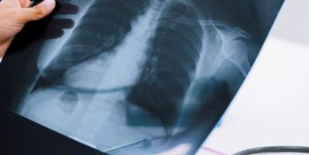 Trudne przypadki raka płuca zyskują realną szansę na leczenie