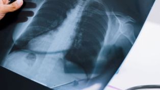 Trudne przypadki raka płuca zyskują realną szansę na leczenie
