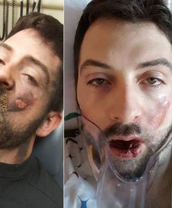 Stracił 7 zębów po tym, jak e-papieros wybuchł mu w twarz