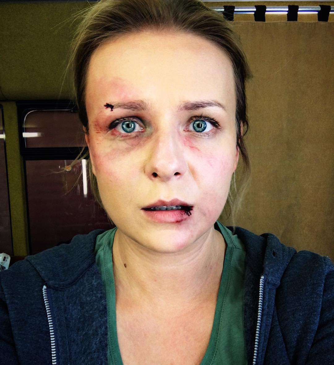 Aneta Zając pokazała swoja zmasakrowana twarz