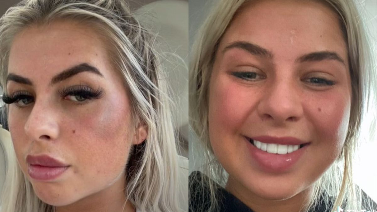 Zrobiła sobie wypełnianie policzków. Tak wygląda jej twarz 